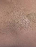 Underarm Laser Hair Removal Before