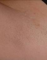Underarm Laser Hair Removal After