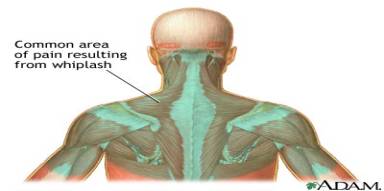 Location of Whiplash Pain
