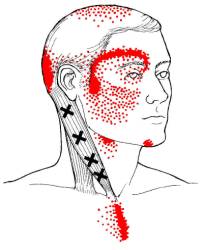 Headache Trigger Points.  Get help in San Antonio, Texas