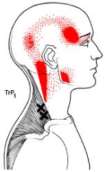 Headache Trigger Points. Massage in San Antonio, Texas helps.