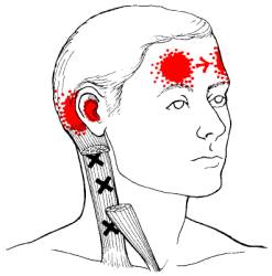 Massage helps these headache trigger points.